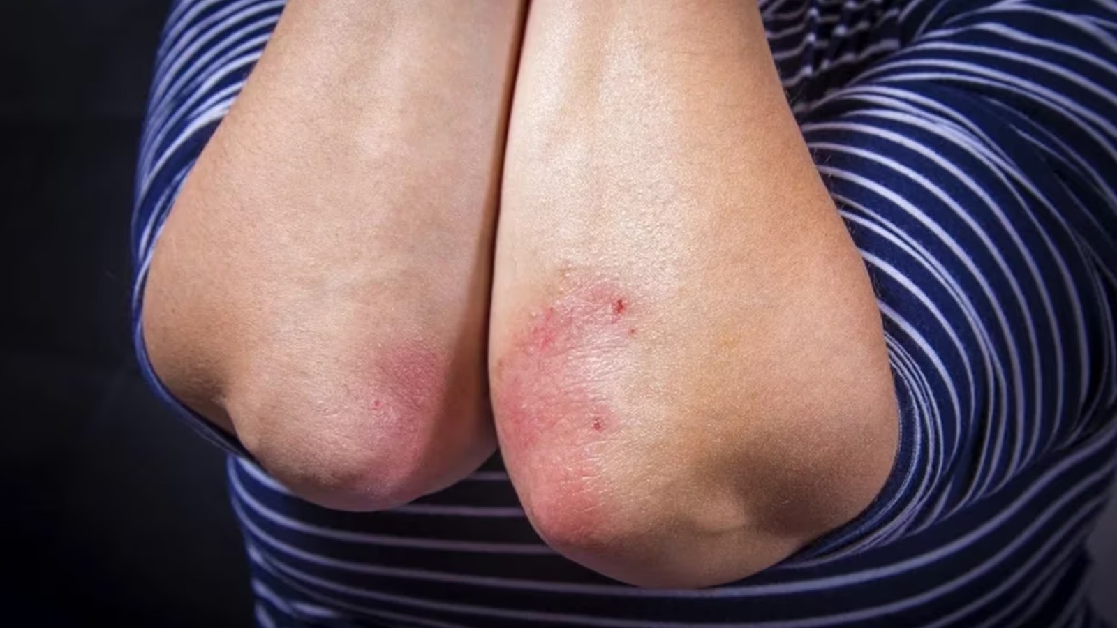 Dermatitis atópica, qué es.