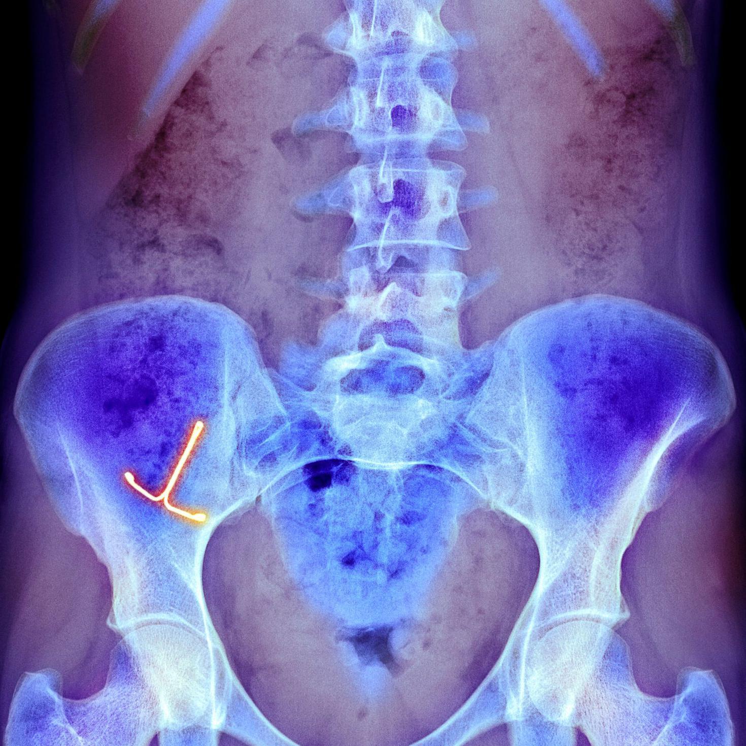 Una radiografía muestra un dispositivo anticonceptivo intrauterino  en el  vientre de una mujer