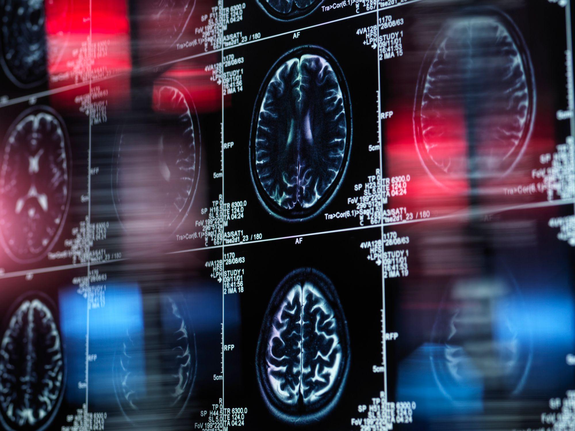 Resonancias magnéticas de un cerebro