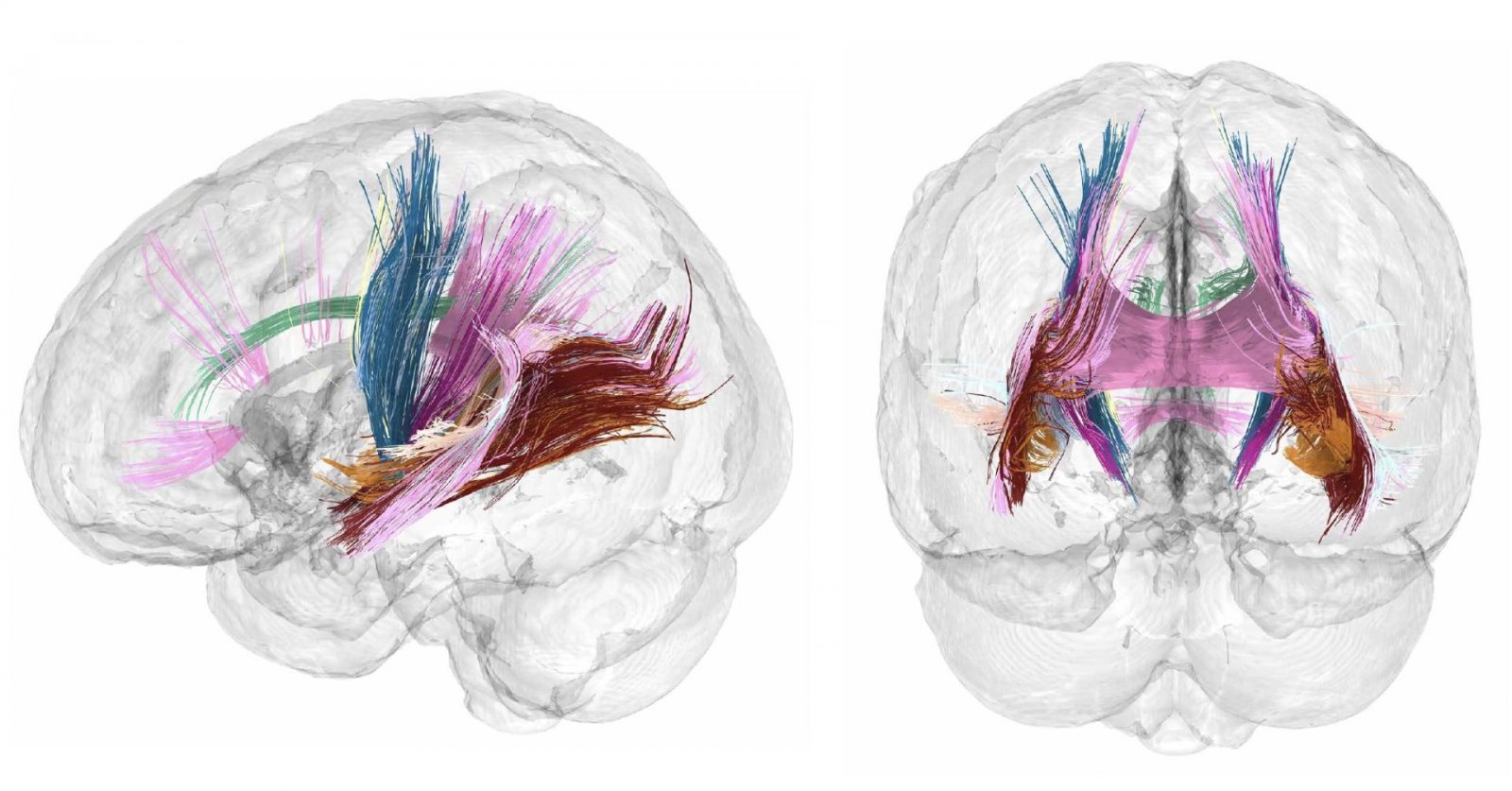 El volumen de materia gris cortical se reduce conforme avanza un embarazo. Los colores más oscuros indican las regiones que más reducen el volumen de materia gris durante la gestación.Crédito: Laura Pritschet